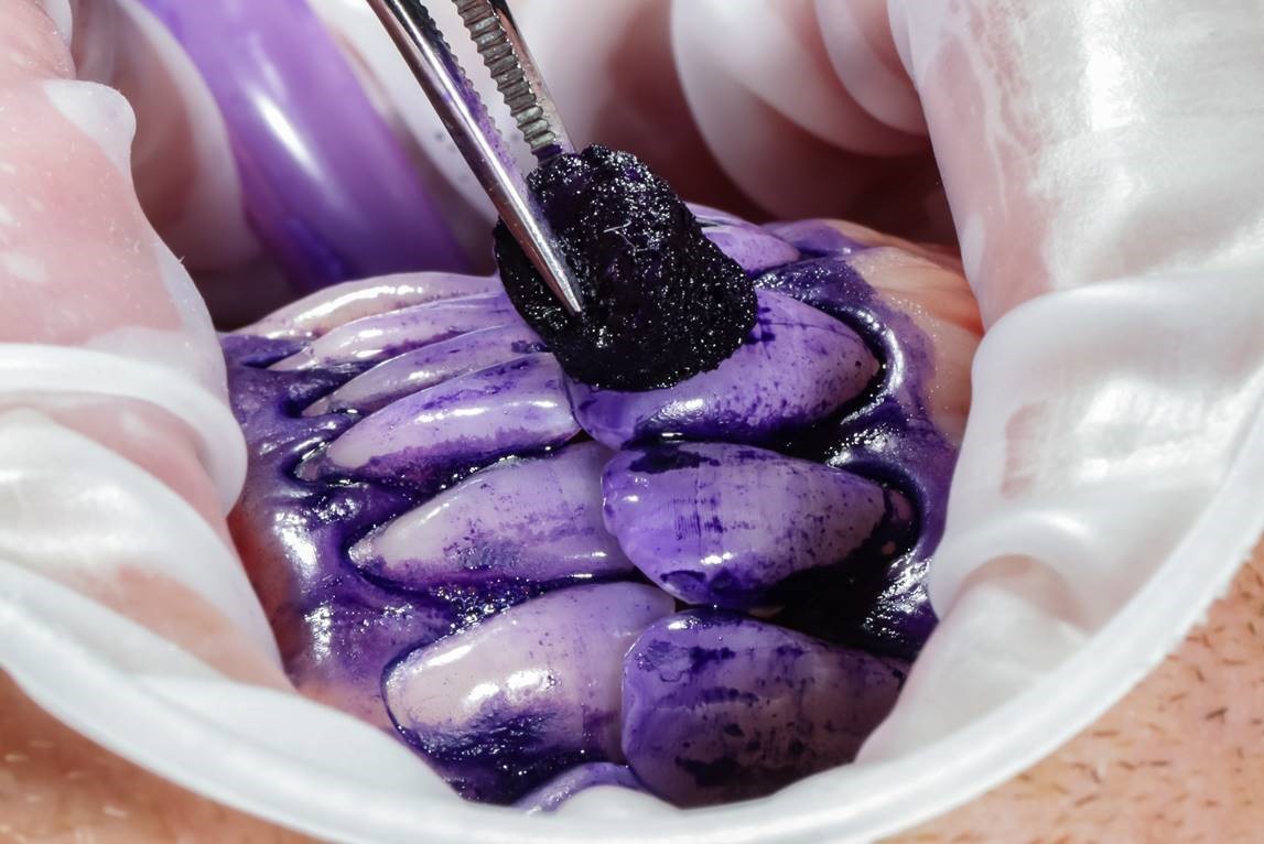 Denti e gengive dopo l'applicazione del rivelatore di placca: le zone colorate indicano dove si è accumulato il biofilm